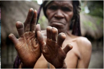 Finger Cutting Dani Tribes Ritual 1